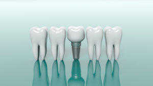 dental implants Metairie LA