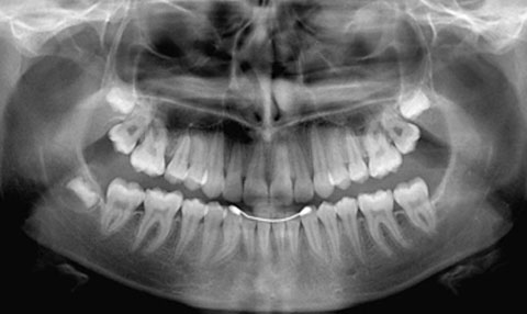 teeth x-ray
