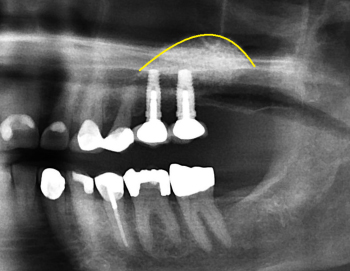 crowns added to dental implant