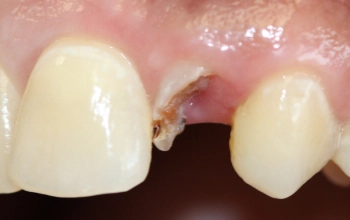 decayed fractured tooth