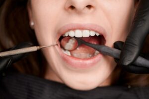 Discover the wisdom teeth removal cost in Metairie, LA, and how to prepare.